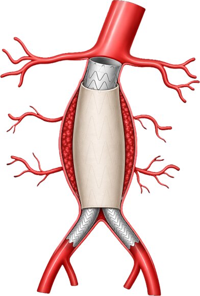 Bill Colone Launches Startup to Improve Aneurysm Repair - Orange County Business Journal