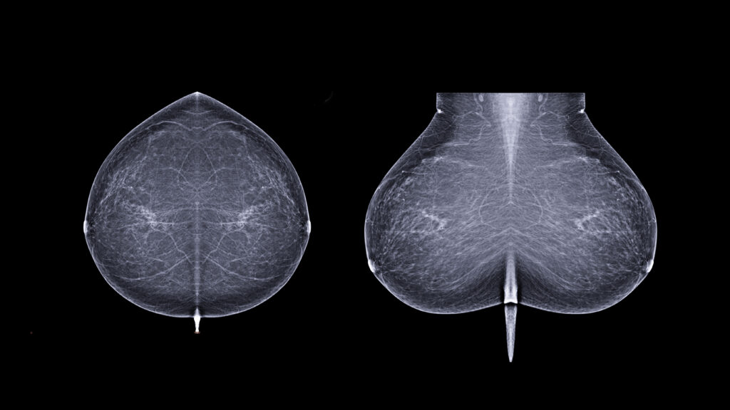 Why this startup is taking its AI to predict breast cancer risk directly to patients